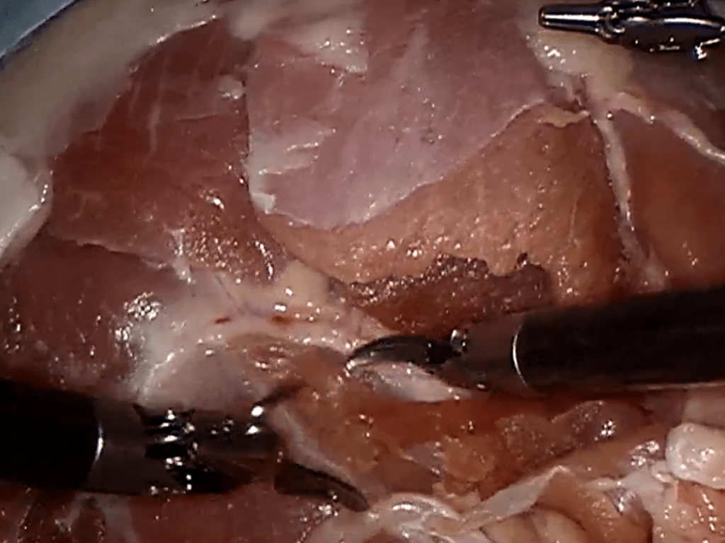 Read more about the article Reduction in Surgical Site Infections (SSI)